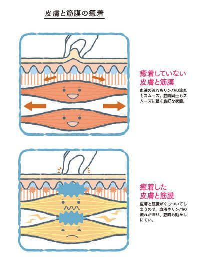 30代40代の腕コリ 腰痛が改善 解消 簡単で時短 はがトレ 2大方法 ヨムーノ